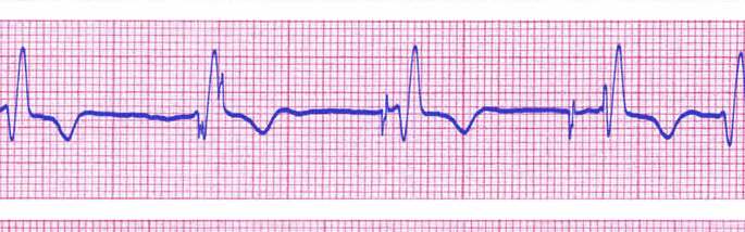 ECG