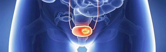 carcinoma uroteliale
