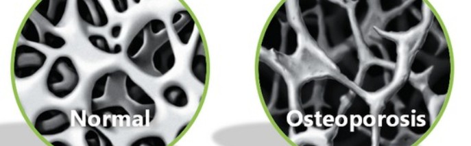 osteoporosi copia