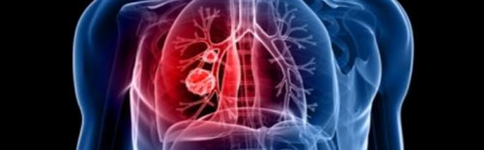 tumore-polmone